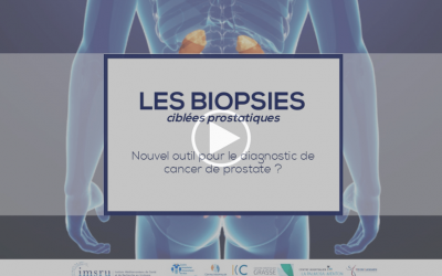 Les biopsies ciblées de prostate